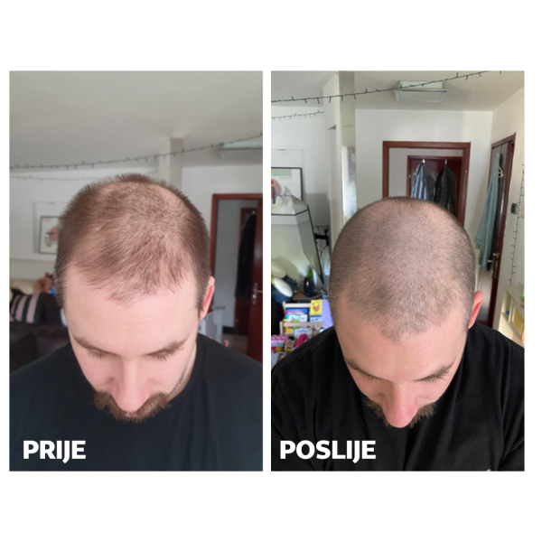 Skinage HAIR Strong MEN 60s Capsules SET( Capsules +Spray)