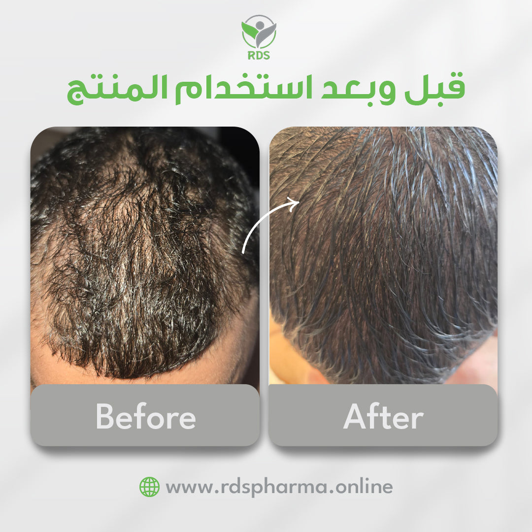 Skinage HAIR Strong MEN 60s Capsules SET( Capsules +Spray)